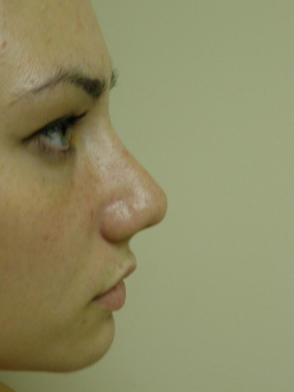 Rhinoplasty Before & After Patient #4180