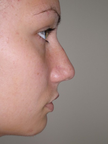 Rhinoplasty Before & After Patient #4180