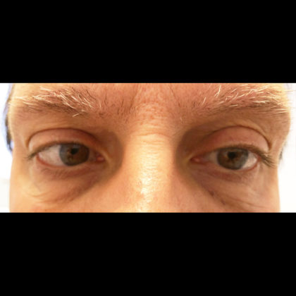 Eyelid Surgery Before & After Patient #6689