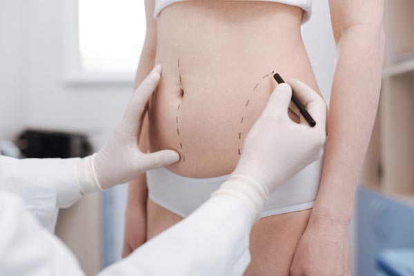 tummy tuck v. liposuction