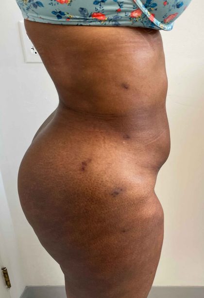 Tummy Tuck Before & After Patient #7065