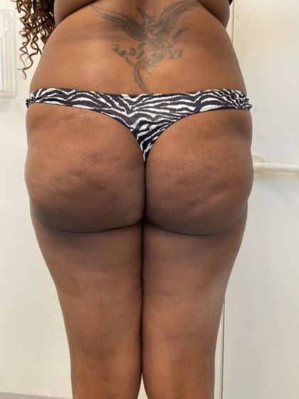 Brazilian Butt Lift Before & After Patient #7382