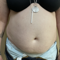 Abdominoplasty Before & After Patient #7728