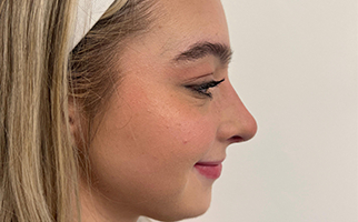 Rhinoplasty Before & After Patient #7713